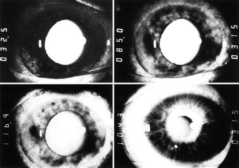 Ocular Ischemic Syndrome | Ento Key