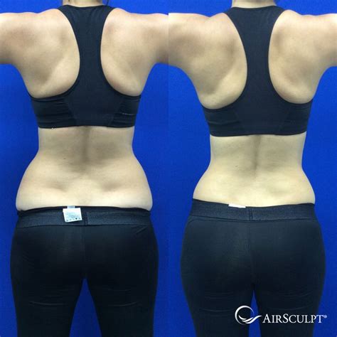 Pin On Airsculpt® Before And After Elite Body Sculpture