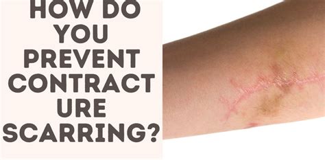 How Do You Prevent Contracture Scarring? - Treat Your Scars