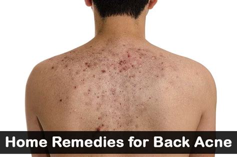 Home Remedies for Back Acne