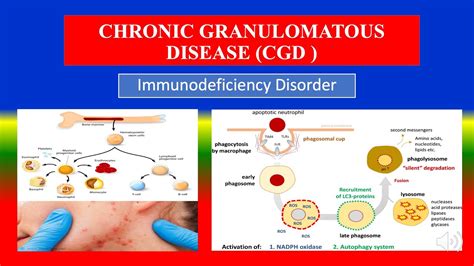 Chronic Granulomatous Disease Cgd Definition Types Causes