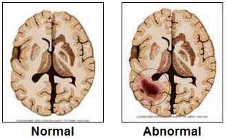 Brain (malignant glioma) Tumors