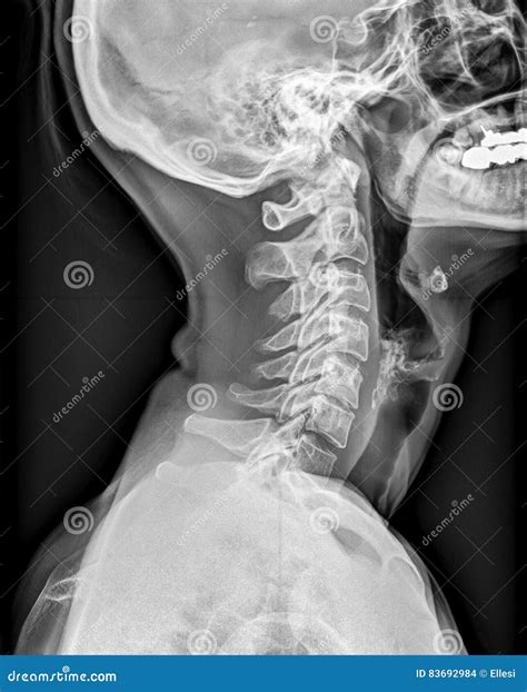 Proyección De Imagen De La Radiografía De La Cabeza De La Columna