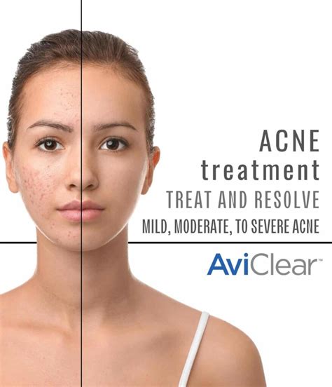 AviClear Acne Treatment | U.S. Dermatology Partners