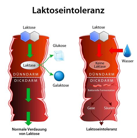 Laktoseintoleranz