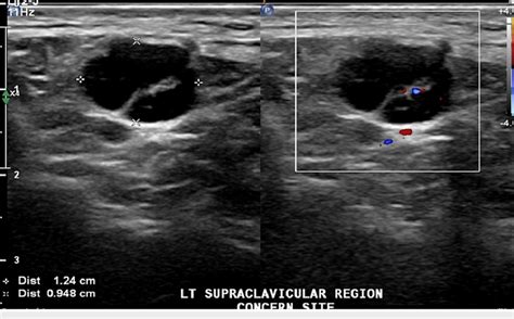 Grayscale (left) and color Doppler (right) ultrasound of the left ...