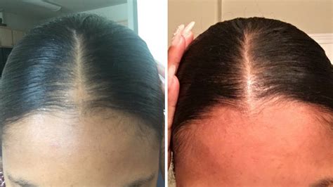 Top 100 Image How To Regrow Hair On Bald Spot Fast Vn