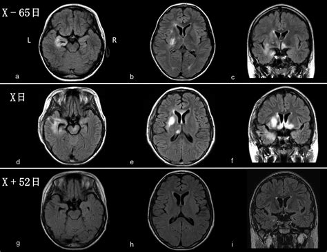 非典型的な臨床経過をしめした抗n Methyl D Aspartate（nmda）受容体脳炎の1例