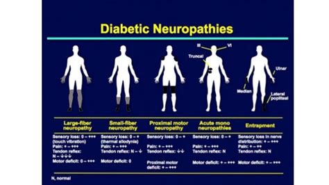 Polyneuropathy Types Demyelinating polyneuropathy barre inflammatory cidp chronic syndrome ...