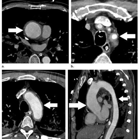 A Axial CT Angiogram Obtained At The Level Of The Ascending Aorta