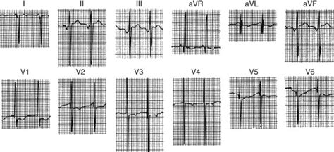 Cyanotic Congenital Heart Defects | Thoracic Key