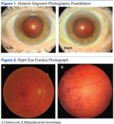 Hypoperfusion Retinopathy MDedge