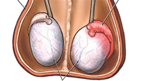 Testis Kanseri Testis Kanseri Neden Olur DoktorTakvimi