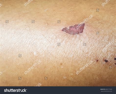 Skin Abrasion Stock Photo 689177569 | Shutterstock