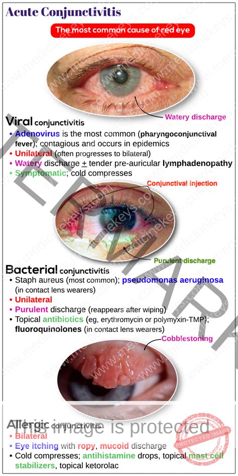 Acute Conjunctivitis Medicine Keys For MRCPs