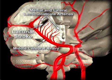 Cerebrovascular Disease Part Neuro Flashcards Quizlet