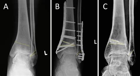 A 30-year-old female with supination-adduction ankle fracture malunion... | Download Scientific ...