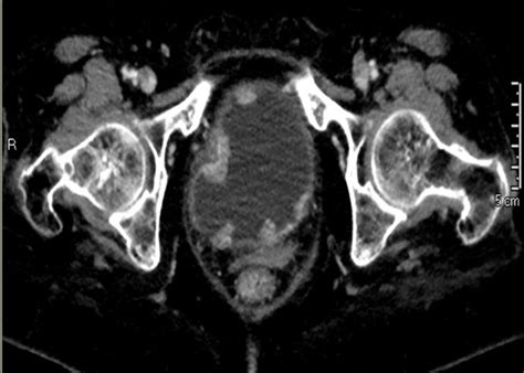 Bladder Metastasis From Lung Adenocarcinoma A Difficult Differential