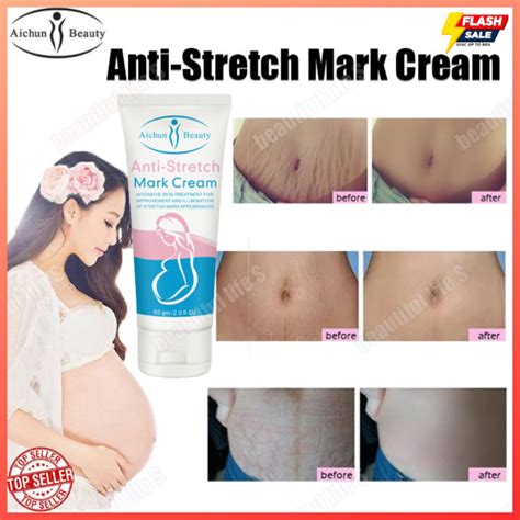 Very Effective Aichun Beauty Anti Stretch Mark Cream Intensive Skin