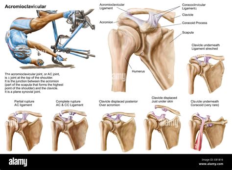 Anatomy Of Acromioclavicular Joint Rupture And Displacement Stock Photo