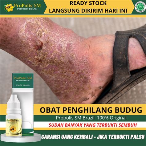 Jual Obat Gatal Budug Obat Penghilang Budug Obat Budug Santri Obat