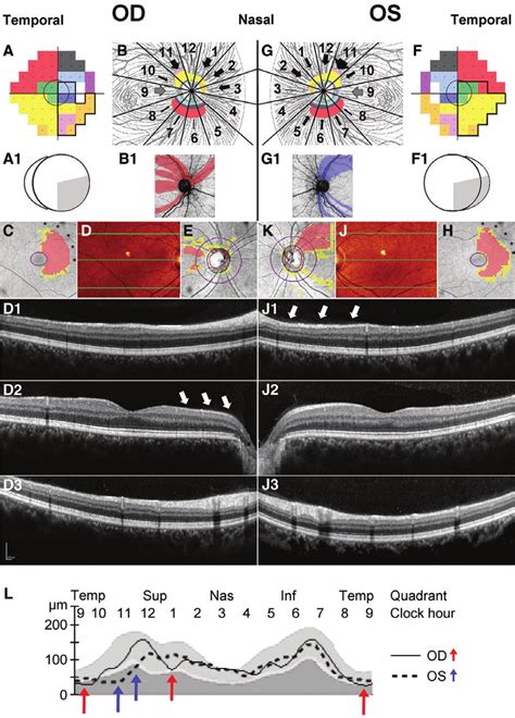 Reconciling Retinal Ganglion Cell And Retinal Nerve Fibre Layer Loss