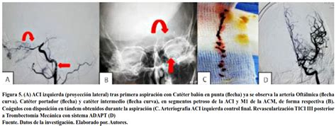 Trombectom A Mec Nica Mediante T Cnica De Aspiraci N Directa De Primer