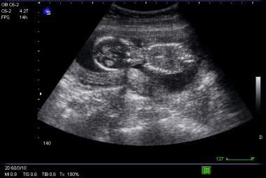 How Soon Can Ectopic Pregnancy Be Detected Ultrasound - PregnancyWalls