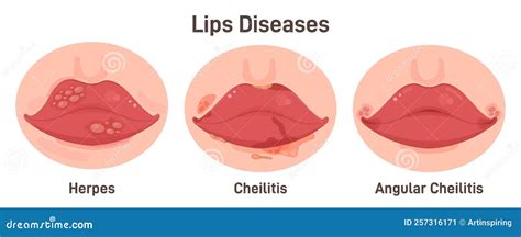 Human Lips Disease Herpes Cheilitis And Angular Cheilitis Stock