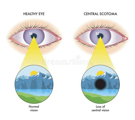 Central scotoma stock illustration. Illustration of medical - 238535815