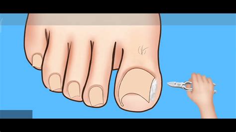 Asmr Ingrown Toenail Removal Treatment Animationstrong Satisfaction