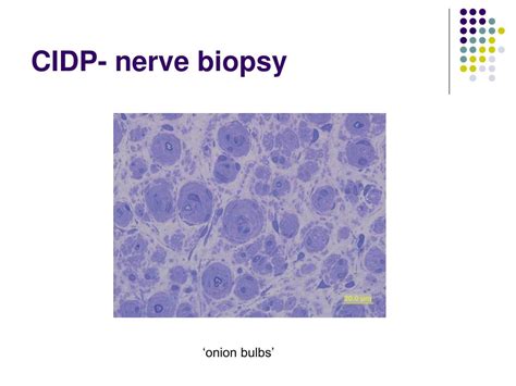 Ppt Polyneuropathies Mononeuropathies Motoneuron Diseases Powerpoint