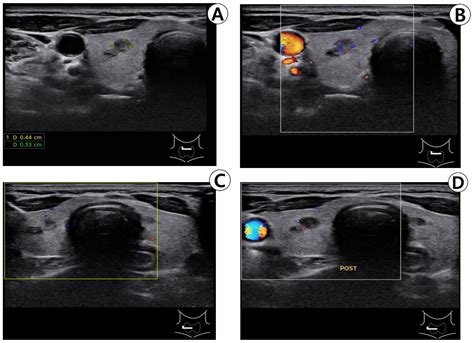 Thyroid Ultrasound