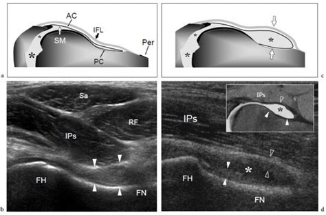 Ultrassonografia Do Sistema Musculoesquel Tico Cap Tulo Quadril