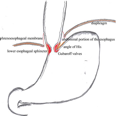 [pdf] Surgical Symposium Contribution Pathophysiology Of Gastroesophageal Reflux Disease