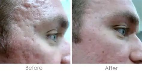 Microneedling Before And After Real Patient Results Skinney Medspa