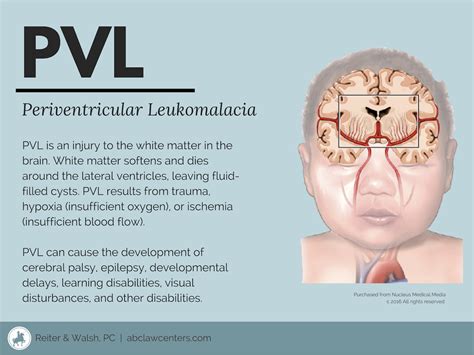 Periventricular Leukomalacia PVL And Birth Injury ABC Law Centers