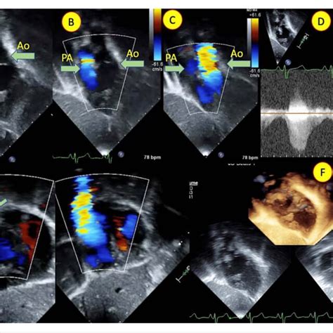 A B C Echocardiogram In Subcostal Oblique View And E Subcostal