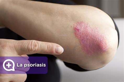 Psoriasis El Tratamiento Para Curarla MediQuo