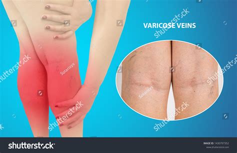 Female Legs Veins Varicose Spider Studio Stock Photo Edit Now