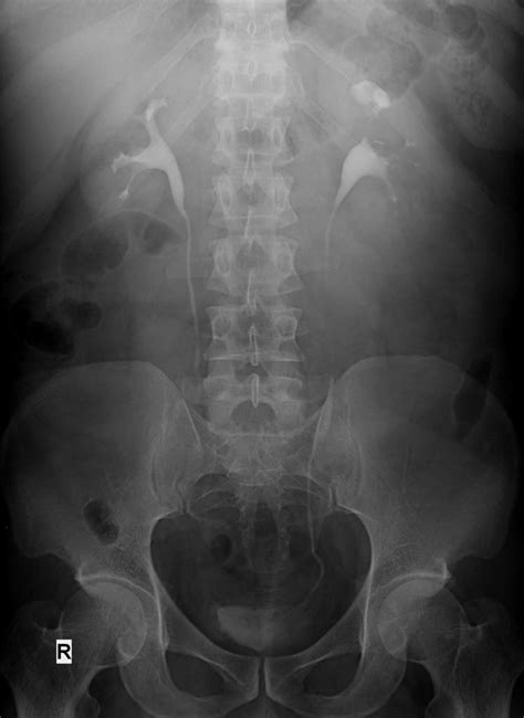 Urinary Bladder In Inguinal Hernia Radiology Case Radiopaedia Org