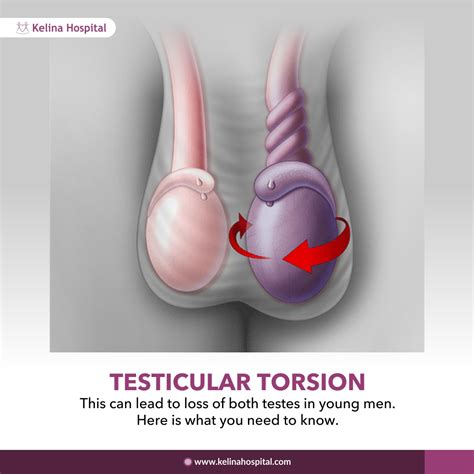 Intermittent Testicular Torsion