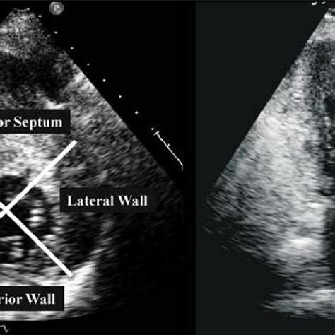 Systolic anterior motion (SAM) of the mitral valve visualized by M-Mode ...