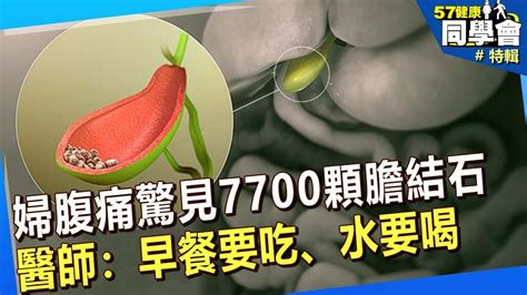 【精選】婦人腹痛驚見「7700顆膽結石」！醫師：早餐要吃、水要喝57healthy Youtube