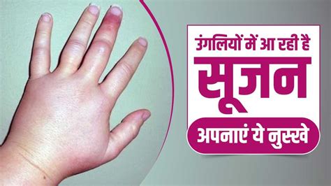 Apply These Home Remedies Tips For Swelling In Fingers In Winter You Will Get Relief Soon In