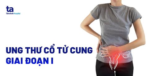 Ung thư cổ tử cung giai đoạn I (giai đoạn đầu): Triệu chứng và điều trị ...