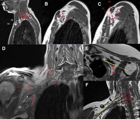 Brachial Plexus Injury Mri