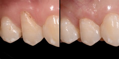 Cirurgia Plástica das Gengivas ORA Clínica Medicina Dentária