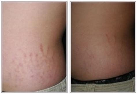 Stretch Marks Striae Treatment Beauty And Laser Clinic