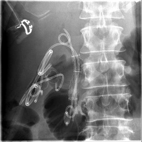 Fluoroscopic view following EUS guided gallbladder drainage with 10 Â